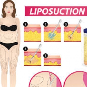 liposuction01
